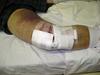Knee Operation